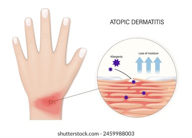 Eczema. Atopic dermatitis vector. Close-up of human skin with dermatitis. Penetration of allergens causes skin allergies. 