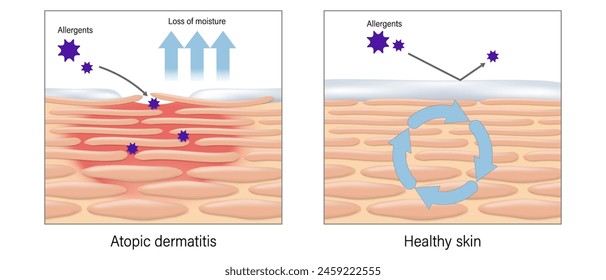 Eczema. Atopic dermatitis vector. Comparison between topic dermatitis and healthy skin. Penetration of allergens causes skin allergies.