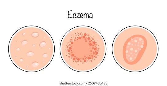 Eccema. Una enfermedad inflamatoria crónica de la piel acompañada de picazón, enrojecimiento y erupciones en forma de Pequeñas ampollas con líquido. Manifestaciones de eccema en la piel. Vector.