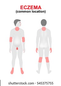 Eczema, dermatitis. Areas of the body most commonly affected. Women silhouette with highlighted location of the disease.