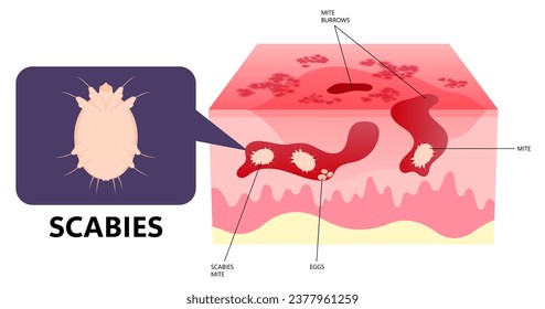 Eczema or dermatitis of skin red and itching