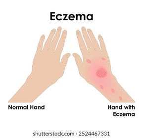 Eczema Mão E Mão Normais Com Ilustração De Vetor De Eczema