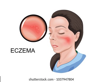 eczema on the face