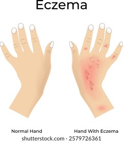 Eczema on Hand Design Vector Illustration