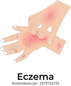 Eczema on Hand Design Vector Illustration