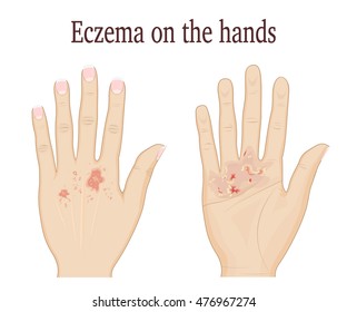 Hand Eczema Hd Stock Images Shutterstock