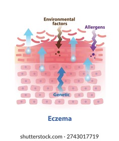 Eczema on skin layer illustration. Cross section of Atopic dermatitis, dry, scaly, itchy, red, inflamed skin. Allergens, genetic and environmental factors leads to this condition. Skin care concept.