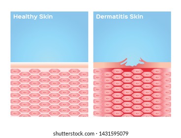 935 Atopic dermatitis Stock Vectors, Images & Vector Art | Shutterstock