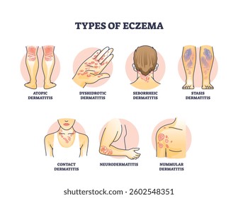 Eczema types diagram shows atopic, dyshidrotic, and seborrheic dermatitis with clear labels. Outline diagram.
