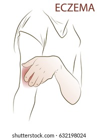 Eczema. A Woman Scratches Her Hand On Which Is Eczema. Colored Vector Illustration Of A Skin Lesion, Itchy Skin.