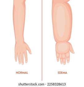 Edema arm. Swollen hand, fingers, wrist, forearm and elbow, vector lymphoedema disease. Normal and swollen hands, human body part with fluid retention symptom. Medicine and health care themes