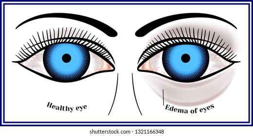 Edema of eyes. svg