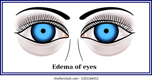 Edema of eyes. svg