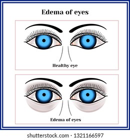 Edema of eyes. svg