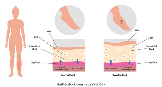 Edema foot. Orthopedist diagram and infographic. Feet disease 