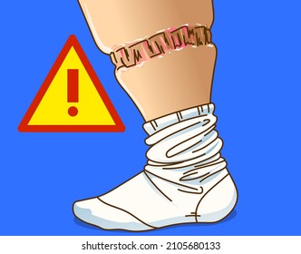 Edema foot, problems with socks wearing. Healthcare illustration. Vector illustration.