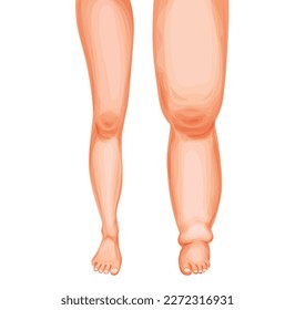 Edema foot. Swollen leg and ankle, vector lymphedema or lymphoedema disease of lymphatic system. Cartoon human feets comparison, healthy and swollen legs, fluid retention, lymph circulatory problems