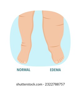 Edema foot swollen leg disease in flat design.