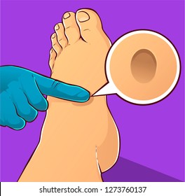 Edema Foot, Vector Illustration