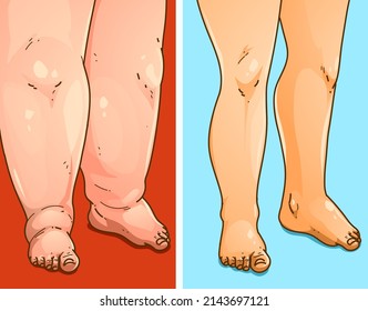 Edema legs. Before, after.  Medical illustration. Vector illustration.