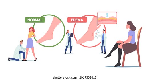 Edema, Lymphedema Disease Concept. Tiny Doctor and Patient Characters at Huge Infographics Presenting Healthy and Diseased Legs, Woman Wear Compression Stockings. Cartoon People Vector Illustration