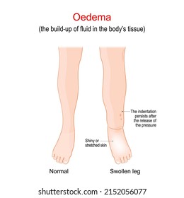 Edema. Swollen ankles, feet and legs. oedema is the build-up of fluid in the body's tissue. Vector illustration. Poster for medical use