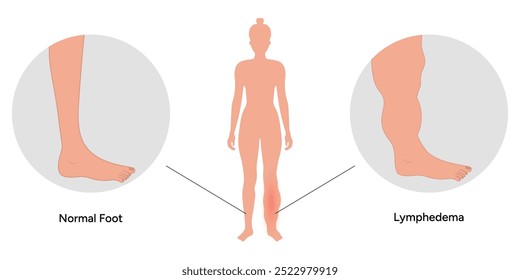 Edema swollen feet. Lymphedema foot. Orthopedist diagram 