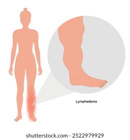 Edema swollen feet. Lymphedema foot. Orthopedist diagram 