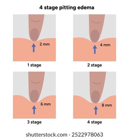 Edema pie hinchado. Edema con picaduras en cuatro etapas