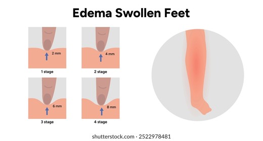 Edema do pé inchado e pé normal, 4 estágios de edema dos pés