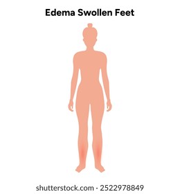 Edema swollen foot and normal foot, medical diagram infographic illustration