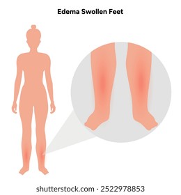 Edema swollen foot and normal foot, medical diagram infographic illustration