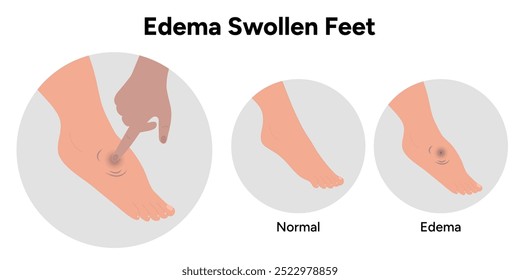 Edema do pé inchado e pé normal, diagrama médico infográfico ilustração