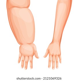 Edema swollen hand or arm. Lymphedema, eodema disease vector. Cartoon human body forearms and hands, swollen and healthy arms, fingers, wrists and elbows comparison