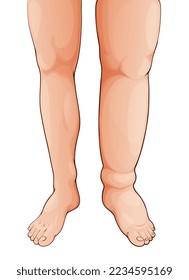 Edema swollen leg and foot. Lymphedema. Oedema disease symptom, fluid retention in legs, lymph circulatory problem and body tissue inflammation or thrombosis syndrome medical vector illustration