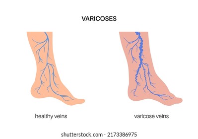 Edema and varicose veins. Swelling and pain in human legs. Vascular disease diagnostic and treatment. Abnormal blood pressure, weak vein and valves. Venous insufficiency medical vector illustration