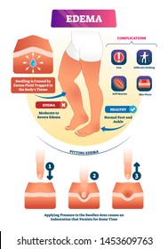 Edema vector illustration. Labeled interstitium fluid accumulation scheme. Skin swelling illness that cause pain. Educational complications and symptoms diagram. Water flow problem in body tissues.