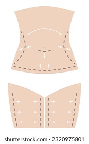 Editable illustration of a female figure in skin color with white underwear, featuring dotted lines and arrows for surgery, liposuction, and fat reduction on the waist, abdomen, legs, and hips.