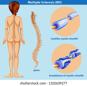 An Education Poster of Sclerosis illustration