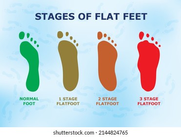 Educational poster about flat feet, different stages of the disease.