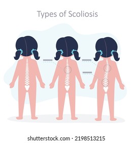 Educational poster with different types of scoliosis. Child with disorders of musculoskeletal system. Example of scoliosis of varying degrees. Spinal curvature concept. Back view. vector illustration