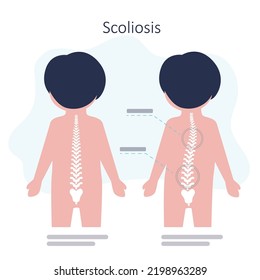 Educational poster with schoolboy have scoliosis problems. Child with disorders of musculoskeletal system. Example of strong scoliosis. Spinal curvature concept. Back view. vector illustration