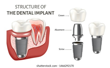 Educational poster showing a structure of the dental implant. Vector illustration isolated on the white background. Medical infographic depicting components of implant: screw, abutment and crown.