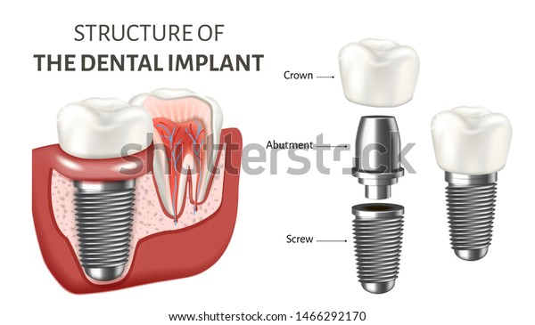 歯科インプラントの構造を示す教育用ポスター 白い背景にベクターイラスト インプラントのコンポーネントを表す医療インフォグラフィック ねじ アバットメント クラウン のベクター画像素材 ロイヤリティフリー