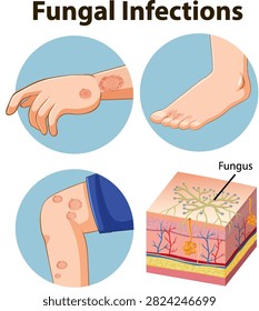 Educational vector diagram illustrating ringworm on limbs and a microscopic skin layer fungus cross section.
