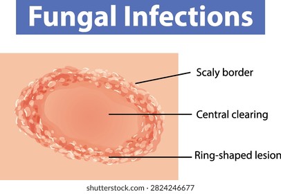 Educational vector diagram showing a ring-shaped lesion with scaly border and central clearing on skin.
