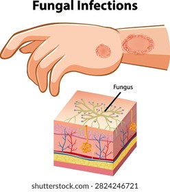 Educational vector diagram showing ringworm on a human hand and a detailed skin cross section.