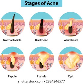 Educational vector illustration showing normal follicle, blackhead, whitehead, papule, pustule, and cyst skin conditions.