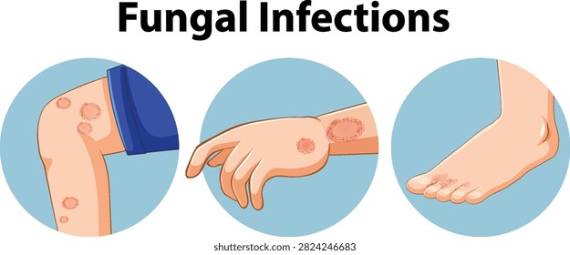 Educational vector illustration showing ringworm and fungal rashes on human limbs in circular frames.