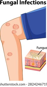 Educational vector illustration showing ringworm symptoms on skin with a detailed cross-section of fungal growth.
